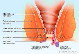 Possible symptoms of bowel cancer: Difference Between Piles And Fistula And Fissure India Explained