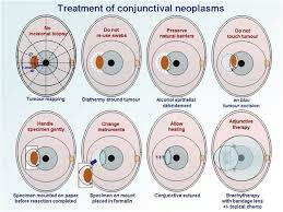 Image result for conjunctival melanoma