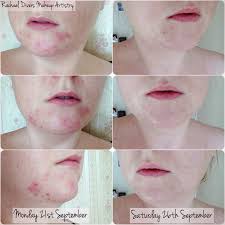 My skin is very sensitive and prone to breaking out and rashes. Arbonne Clear Future Acne Skincare Review