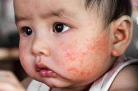 Trẻ Bị Chàm Sữa Tắm Lá Gì