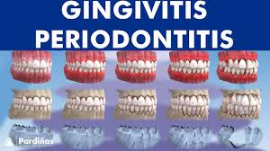 Image result for Periodontitis