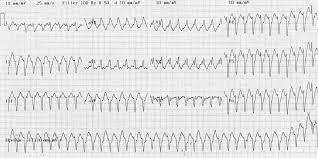 .waves & complexes, leads, electrocardiograph, ectopy & aberrancy, paced rhythms, asystole no expert here, just a novice like most but i think it is svt w/ aberrancy. Vt Versus Svt Litfl Medical Blog Ecg Library Basics