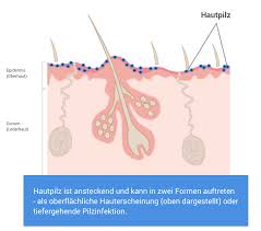 Hautpilz Ursachen Symptome Behandlung Altmark Apotheke Stendal