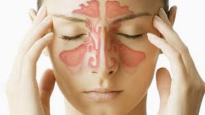 A wide variety of nasal spray sinusitis options are available to you, such as 1 year. Minus Your Sinus Problem Dhaka Tribune