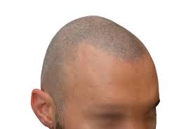 We respond and act quickly. Permanent Or Temporary Smp Alliance4hair Com
