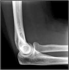 Image result for Elbow XRay