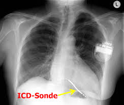 Der defibrillator erkennt über ein elektrogramm einen schnellen und lebensbedrohlichen herzrhythmus. Implantation Von Herzschrittmachern Und Defibrillatoren Universitatsklinikum Ulm