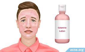 Here's why you it in your life. Does Calamine Lotion Clear Acne Acne Org