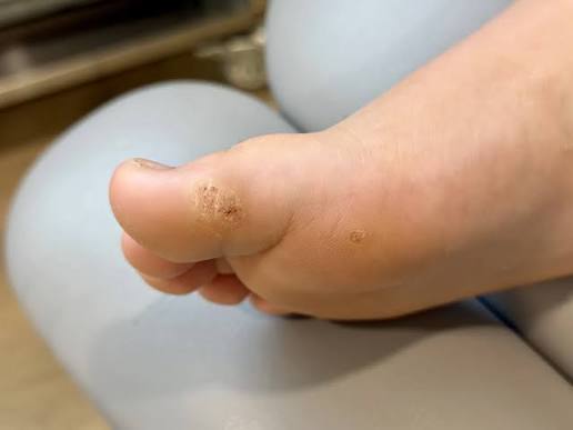 Plantar Wart Symptoms, Causes & Removal | Straits Podiatry