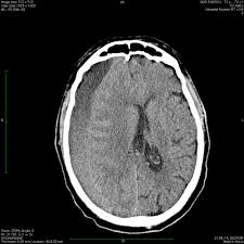 Subdural Hematoma Amboss