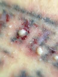 Laser treatment will usually remove unwanted tattoos completely, although it will take several. Laser Tatoo Removal Something To Get Off My Chest