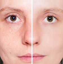 Image result for Freckled skin