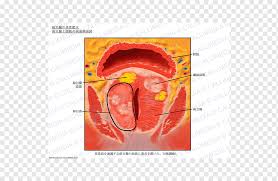 La prostata, detta anche ghiandola prostatica, è una ghiandola dell'apparato genitale maschile situata sotto la vescica. Imagen De Prostata Anatomia Imagen De Resonancia Magnetica Vejiga Urinaria Bexiga Anatomia Prostata Nervio Png Pngwing