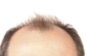 It can be temporary hair loss that contributes to alopecia. What Causes Male Pattern Baldness Wild About Beauty