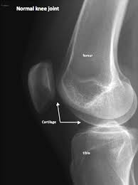 Image result for Knee XRay