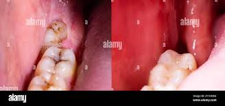 Image result for Alveolitis sicca)