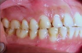 Herpes simplex virus infections may be caused by two virus genotypes: Acute Herpetic Gingivostomatitis Associated With Herpes Simplex Virus 2 Report Of A Case Abstract Europe Pmc