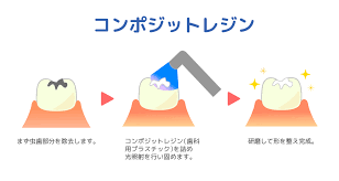 むし歯を削ってつめたりかぶせる治療 - うつぎざき歯科医院