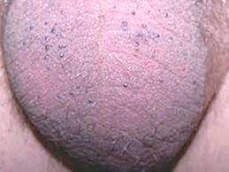 Dermabia