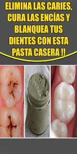 Elimina Las Caries Cura Las Encias Y Blanquea Tus Dientes Con Esta Pasta Casera Caries Encias Dientes Pasta Cons Caries Quitar Caries Curar Las Caries
