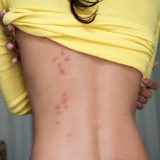 If the burn is not treated properly, a mark can remain on the skin. Bed Bug Bites Pictures Symptoms What Do Bed Bug Bites Look Like