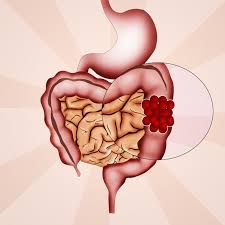 Fear of a cancer diagnosis shouldn't keep you away from seeing your health care provider if you are experiencing symptoms. Antidepressant Use After Colon Cancer Diagnosis Does Not Increase Risk Of Recurrence Latest News For Doctors Nurses And Pharmacists Oncology