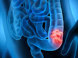 At one point i got very constipated and passed a larger stool. Colorectal Cancer Care At Mount Sinai South Nassau
