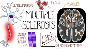 Image result for Multiple Sclerosis