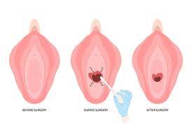 Medical illustration showing stages of a cosmetic gynecology procedure