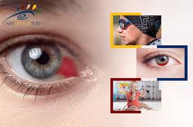 Image result for Hyphema