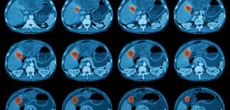 A ct scan can be used to measure the tumor's size and find out how much the cancer has spread. How Long Does A Ct Scan Of The Abdomen Take American Health Imaging