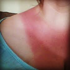 Btdt Anyone Ever Had A Sunburn During Pregnancy Pic Included Babycenter
