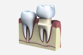 Get directions, reviews and information for denture care center at abbeville in lubbock, tx. Dental Crowns Dental Bridges In Lubbock Tx 79424 Akj Dentistry