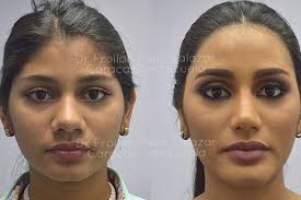 Consultations, surgeries, electrolysis/laser, hair transplants, injectables and plasma treatments can go on as planned due to their medical nature. Before And After Surgery Photos Of Miss Universe Venezuela Go Viral Abs Cbn News