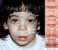 Epicanthal folds are oblique or vertical folds from the upper or lower eyelids towards the medial canthus. Fetal Alcohol Syndrome An Overview Sciencedirect Topics