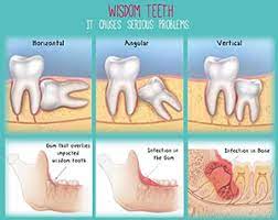 Crest.com has been visited by 10k+ users in the past month Glendale Wisdom Teeth Glendale Oral Surgeon Glendale Wisdom Teeth Removal Glendale Oral Surgery Wisdom Teeth Extraction