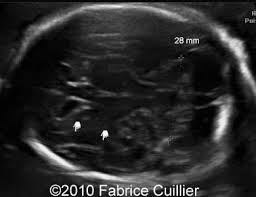 Enlarged Cisterna Magna Ultrasound Sonography Student Sonography