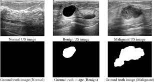 Ovarian cancer on 3d ultrasound. Dataset Of Breast Ultrasound Images Sciencedirect