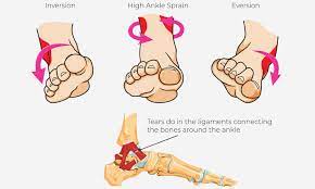 Treating A Sports Injury: Healing Time & Process | Health Plus