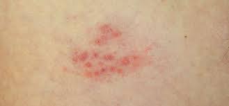 Check spelling or type a new query. Pasovy Opar Herpes Zoster Medixa Org