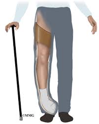 Club foot may, in rare instances, be associated with spinal deformities such as spina bifida or other neuromuscular diseases; Clubfoot Eorthopod Com