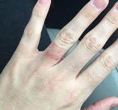 Nickel Allergy And Your White Metal Choices Calla Gold Jewelry