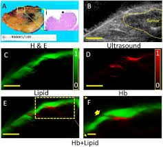 I created the clear margins space. Optoacoustic Characterization Of Breast Conserving Surgery Specimens A Pilot Study Sciencedirect