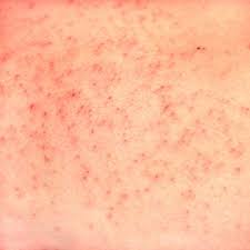 Vellus Hair Cyst Basicmedical Key