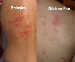 What causes shingles in young adults. Chickenpox Shingles And Postherpetic Neuralgia Oudtshoorn Courant