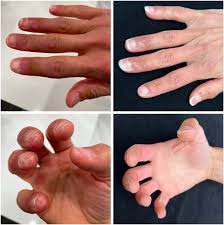 Image result for Chilblains
