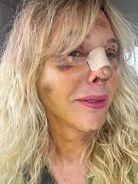 When did you start taking ozempic or saxenda after the rhino surgery?