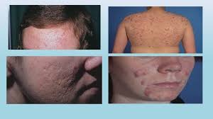 Acne Vulgaris Sebaceous Glands Multilobed Gland With Lipidcontaining