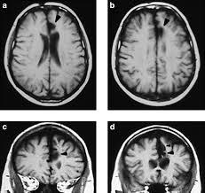 The anterior cingulate cortex (acc) and primary somatosensory cortex (s1) represent two most important cortical circuits related to sensory and affective processing of pain. Dissociation Between Conflict Detection And Error Monitoring In The Human Anterior Cingulate Cortex Pnas