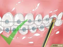 This is pretty normal because as your teeth straighten the wire gets long in the back. 3 Ways To Handle Poking Wires On Braces Wikihow